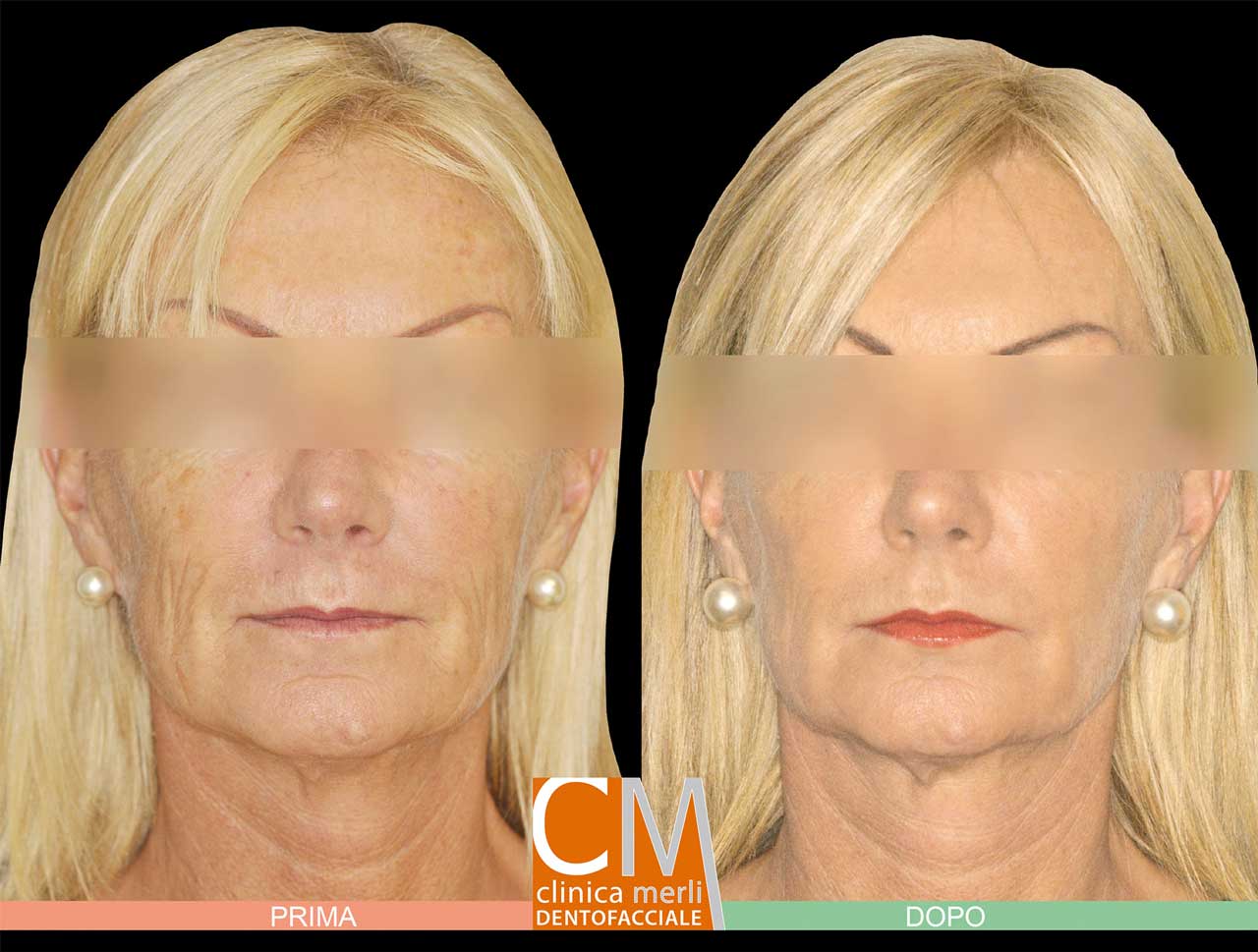 LIPOFILLING