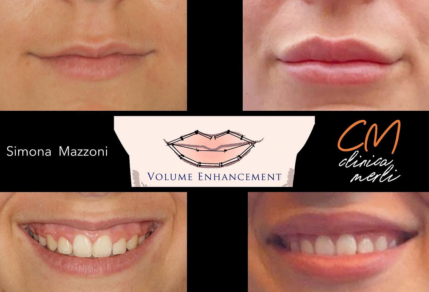 FILLER all’ACIDO IALURONICO