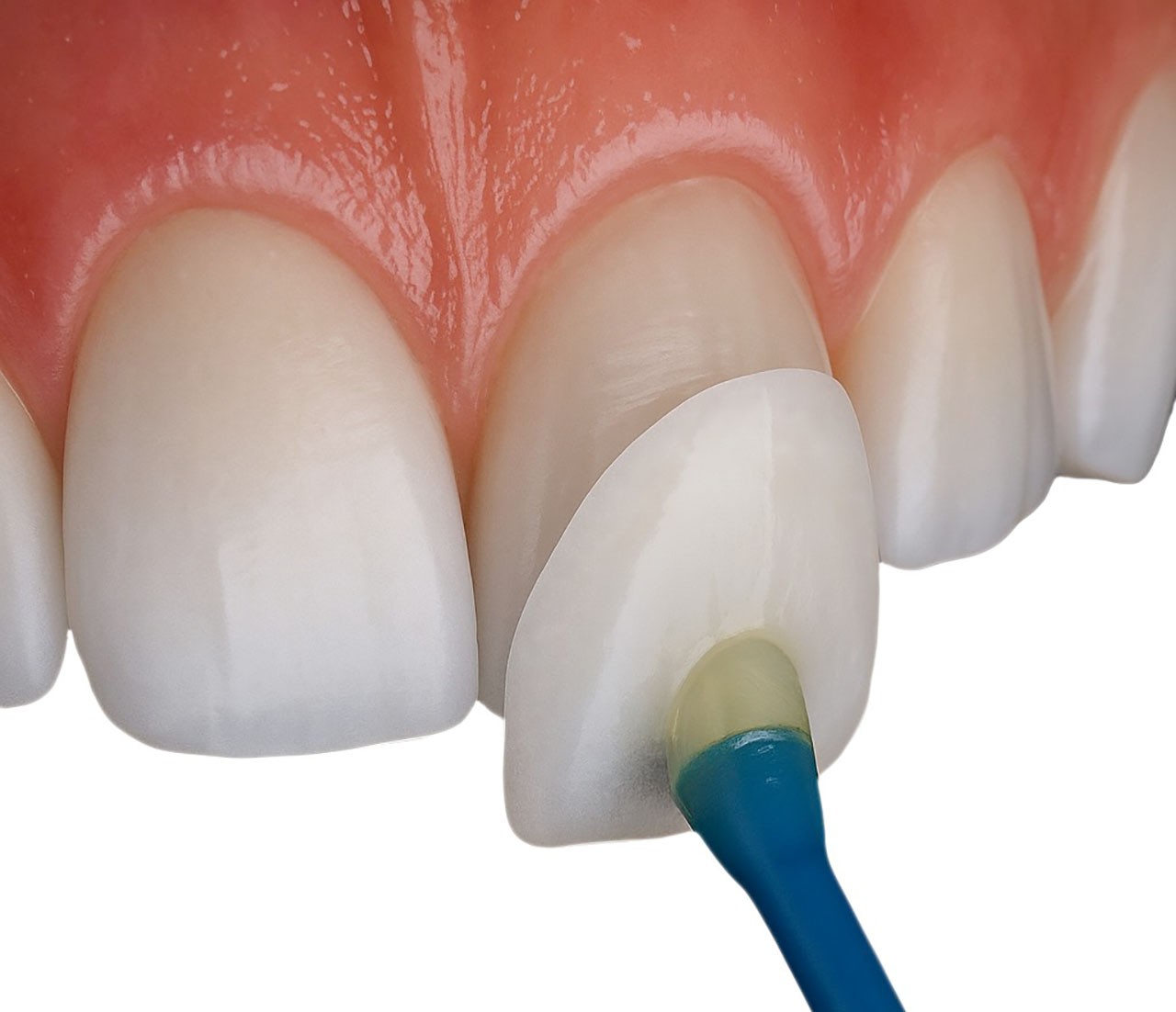 faccette dentali 1
