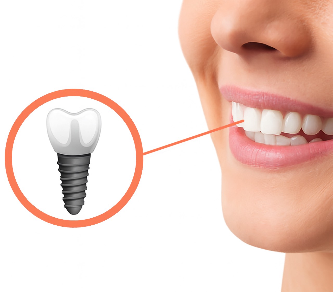 impianto dentale - Clinica Merli