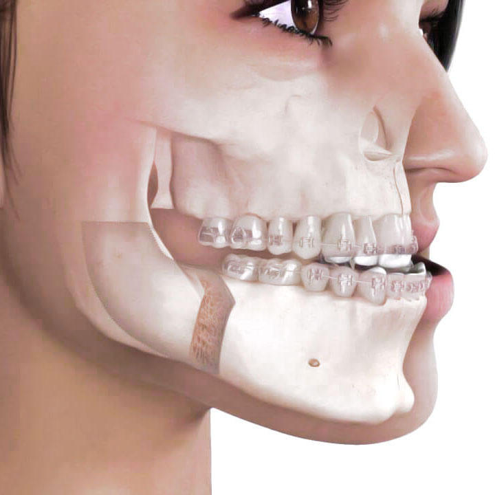 Ortodonzia pre-Chirurgica