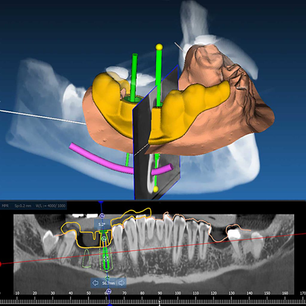 Pianificazione Implantare Virtuale e la Stampa 3D