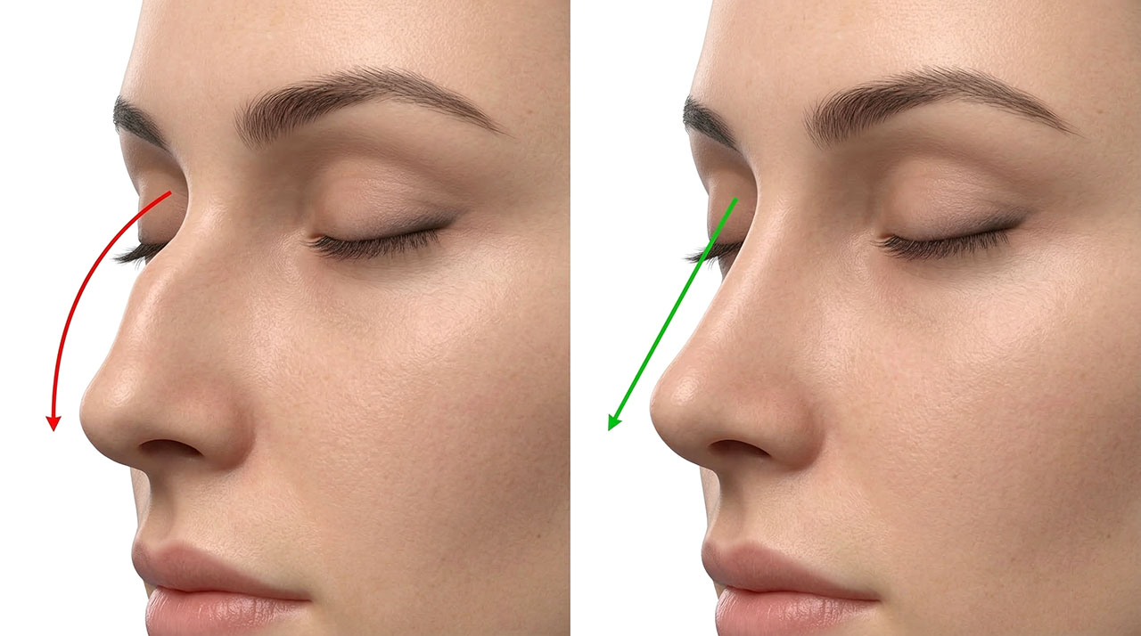 rinofiller-rimodellare-il-naso-senza-bisturi-Clinica-Merli